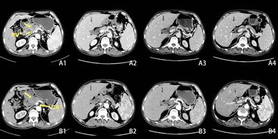 A case report of surgical resection treatment for complete remission after chemotherapy for advanced pancreatic cancer